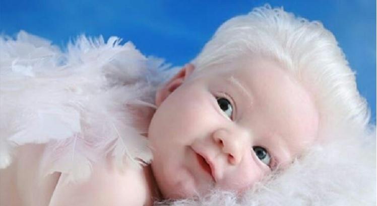 Com síndrome rara, 'bebê platinado' faz sucesso nas redes sociais