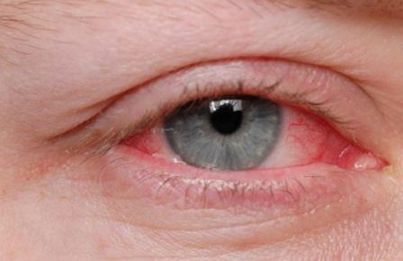 Vermelhidão ocular pode ser sintoma de alergia (Foto: Divulgação)