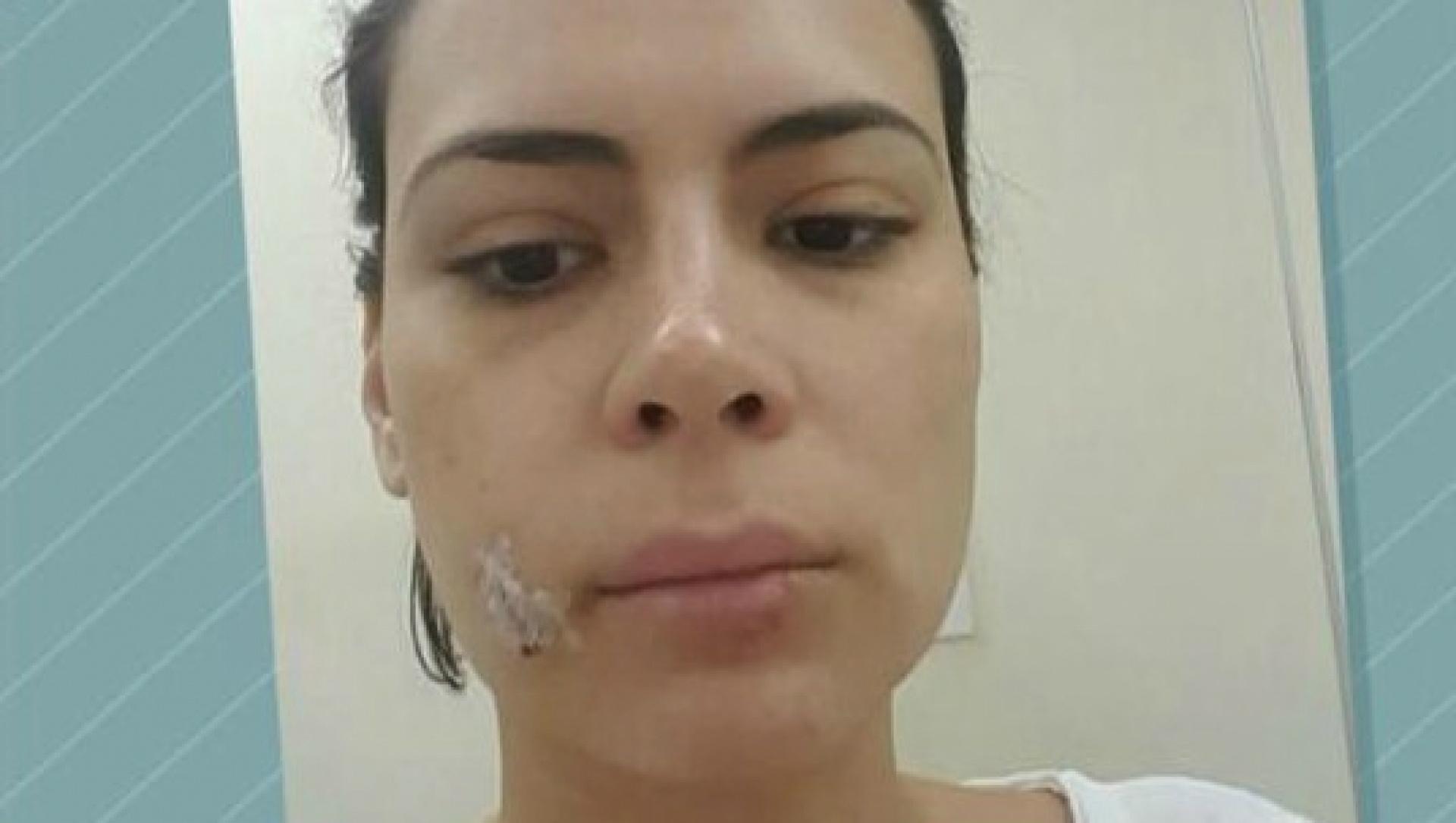 Michelle mostra lesão ocasionada pela mordida repentina. Foto: Reprodução/TV Globo