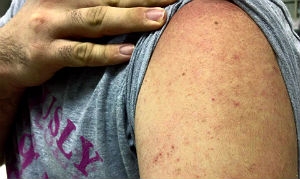 Manchas vermelhas são os primeiros sintomas da "nova dengue"